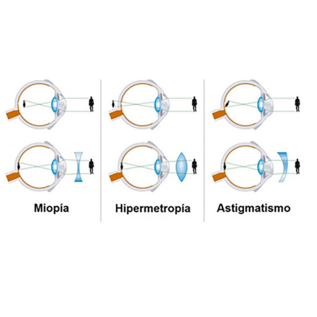 Qual a Melhor Lente de Contato para Quem Tem Miopia e Astigmatismo?